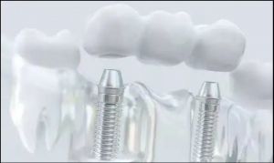 Can General Dentists Perform Dental Implants? Your Guide to Implants in Sherman Oaks
